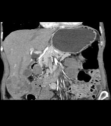 Hepatocellular Carcinoma (Hepatoma) - CTisus CT Scan