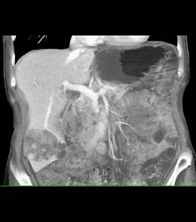 Hepatocellular Carcinoma (Hepatoma) - CTisus CT Scan