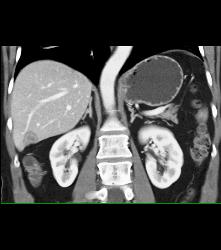 Liver Metastases and Gallstones - CTisus CT Scan