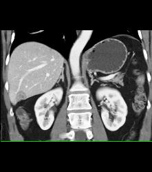 Liver Metastases and Gallstones - CTisus CT Scan