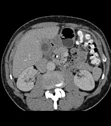 1cm Cholesterol Stone in Common Bile Duct (CBD) Simulates A Tumor - CTisus CT Scan