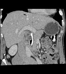 1cm Cholesterol Stone in Common Bile Duct (CBD) Simulates A Tumor - CTisus CT Scan