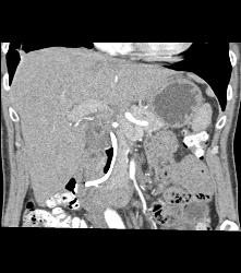 1cm Cholesterol Stone in Common Bile Duct (CBD) Simulates A Tumor - CTisus CT Scan