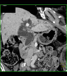 Ampullary Cancer - CTisus CT Scan