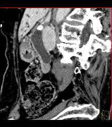 Ampullary Cancer - CTisus CT Scan