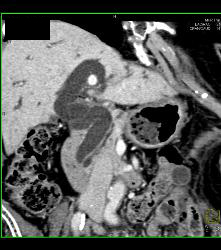 Ampullary Cancer - CTisus CT Scan