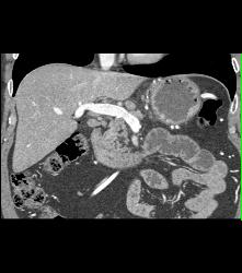 Normal Portal Vein (PV) - CTisus CT Scan