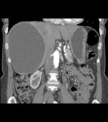 Simple Liver Cyst - CTisus CT Scan