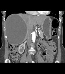 Simple Liver Cyst - CTisus CT Scan