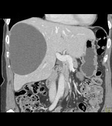 Simple Liver Cyst - CTisus CT Scan