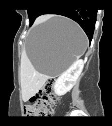 Simple Liver Cyst - CTisus CT Scan