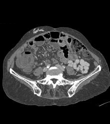 Cirrhosis With Huge Varices - CTisus CT Scan