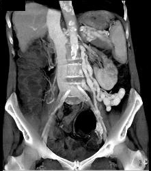 Cirrhosis With Huge Varices - CTisus CT Scan