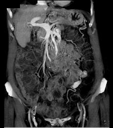 IVC Occlusion With Collaterals - CTisus CT Scan