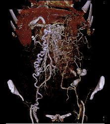 IVC Occlusion With Collaterals - CTisus CT Scan