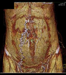 IVC Occlusion With Collaterals - CTisus CT Scan