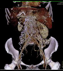 IVC Occlusion With Collaterals - CTisus CT Scan