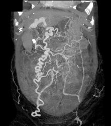 IVC Occlusion With Collaterals - CTisus CT Scan