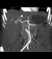 CTA Liver Without Mass - CTisus CT Scan