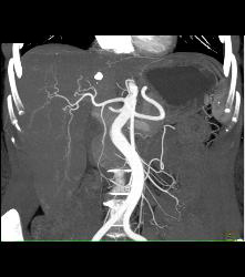 CTA Liver Without Mass - CTisus CT Scan