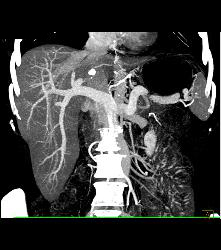 Normal Portal Vein - CTisus CT Scan