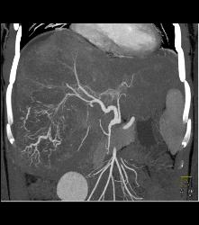 Hepatocellular Carcinoma (Hepatoma) With Neovascularity - CTisus CT Scan