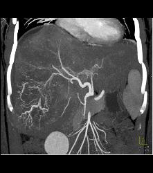 Hepatocellular Carcinoma (Hepatoma) With Neovascularity - CTisus CT Scan