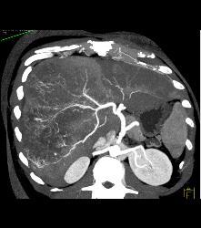 Hepatocellular Carcinoma (Hepatoma) With Neovascularity - CTisus CT Scan