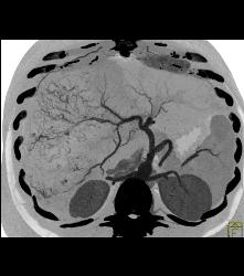 Hepatocellular Carcinoma (Hepatoma) With Neovascularity - CTisus CT Scan