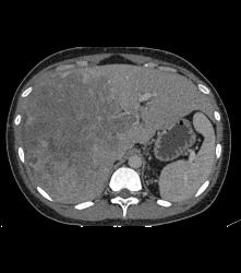 Hepatocellular Carcinoma (Hepatoma) With Neovascularity - CTisus CT Scan