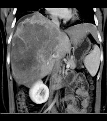 Hepatocellular Carcinoma (Hepatoma) With Neovascularity - CTisus CT Scan