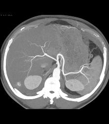 Hemangioma - CTisus CT Scan