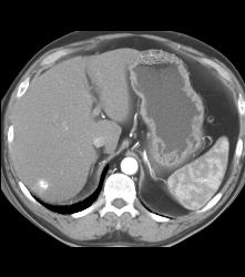 Hemangioma - CTisus CT Scan