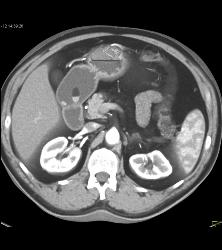 Hemangioma - Liver Case Studies - CTisus CT Scanning