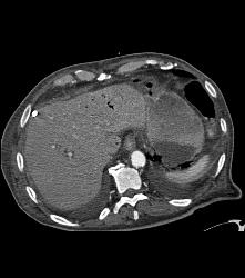 Portal Venous Air and Gastric Emphysema in Post Whipple Patient - CTisus CT Scan