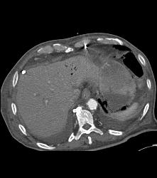 Portal Venous Air and Gastric Emphysema in Post Whipple Patient - CTisus CT Scan