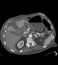 Portal Venous Air and Gastric Emphysema in Post Whipple Patient - CTisus CT Scan