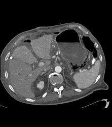 Portal Venous Air and Gastric Emphysema in Post Whipple Patient - CTisus CT Scan