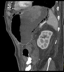 Portal Venous Air and Gastric Emphysema in Post Whipple Patient - CTisus CT Scan