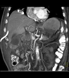 Portal Venous Air and Gastric Emphysema in Post Whipple Patient - CTisus CT Scan