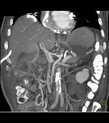 Portal Venous Air and Gastric Emphysema in Post Whipple Patient - CTisus CT Scan