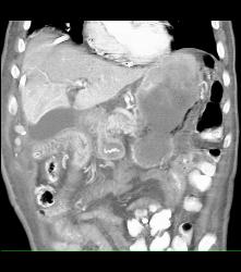 Portal Venous Air and Gastric Emphysema in Post Whipple Patient - CTisus CT Scan