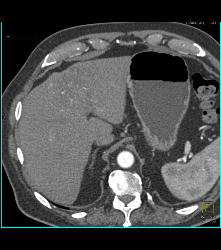 Hepatocellular Carcinoma (Hepatoma) - CTisus CT Scan