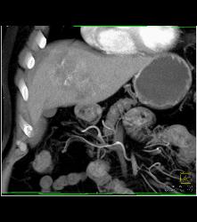 Hepatocellular Carcinoma (Hepatoma) - CTisus CT Scan