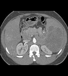 Kaposi Sarcoma in Liver and Spleen- Amazing - CTisus CT Scan