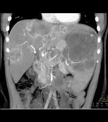 Kaposi Sarcoma in Liver and Spleen- Amazing - CTisus CT Scan