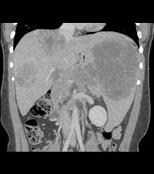 Kaposi Sarcoma in Liver and Spleen- Amazing - CTisus CT Scan