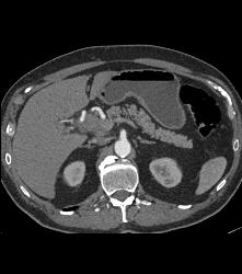 Cholangiocarcinoma With Nodes in Porta - CTisus CT Scan