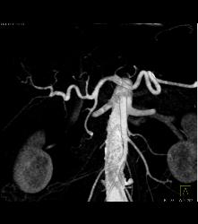 Cholangiocarcinoma With Nodes in Porta - CTisus CT Scan