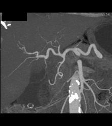 Cholangiocarcinoma With Nodes in Porta - CTisus CT Scan